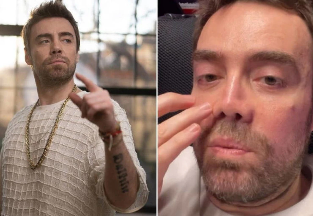 13 kez ameliyat olan Murat Dalkılı&ccedil;: İki sene sonra burnum oldu