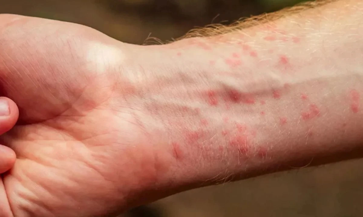 Uyuz Vakaları Artıyor! Uzmandan A&ccedil;ıklama